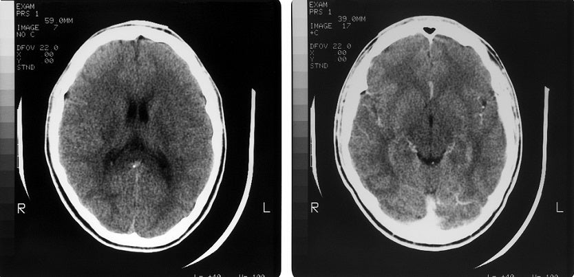 Cerebro