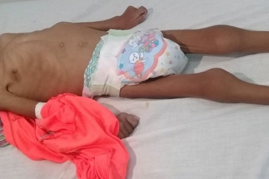Niño indígena sufre desnutrición en Juradó, Chocó