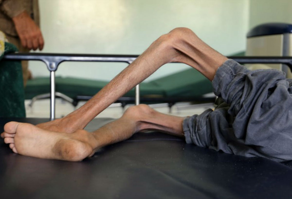 Niños desnutridos en Yemen