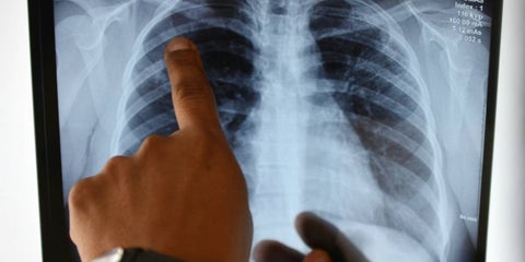 Los científicos han hecho grandes descubrimientos sobre lo que hace el coronavirus en los pulmones.