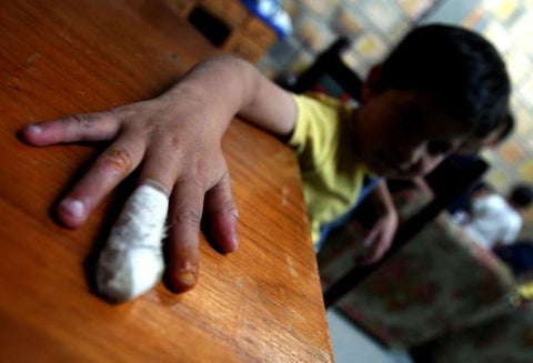 Cero casos de menores de edad quemados en el departamento de Cundinamarca durante Navidad.