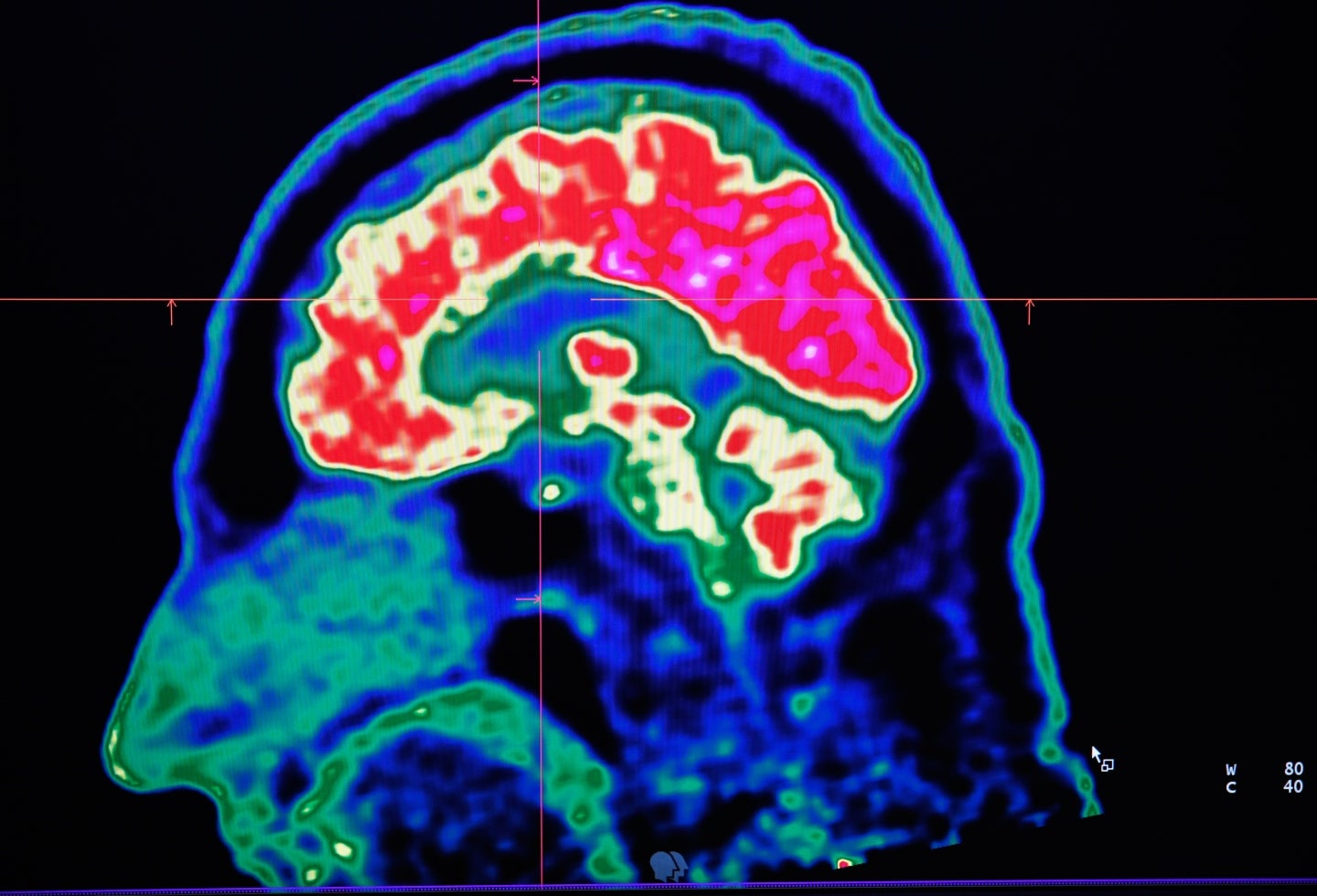 Implante cerebral