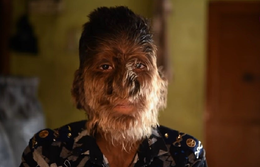 La hipertricosis es una enfermedad conocida como el "síndrome del hombre lobo".
