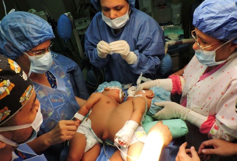 Siamesas en Venezuela, unidas desde el tórax hasta el ombligo