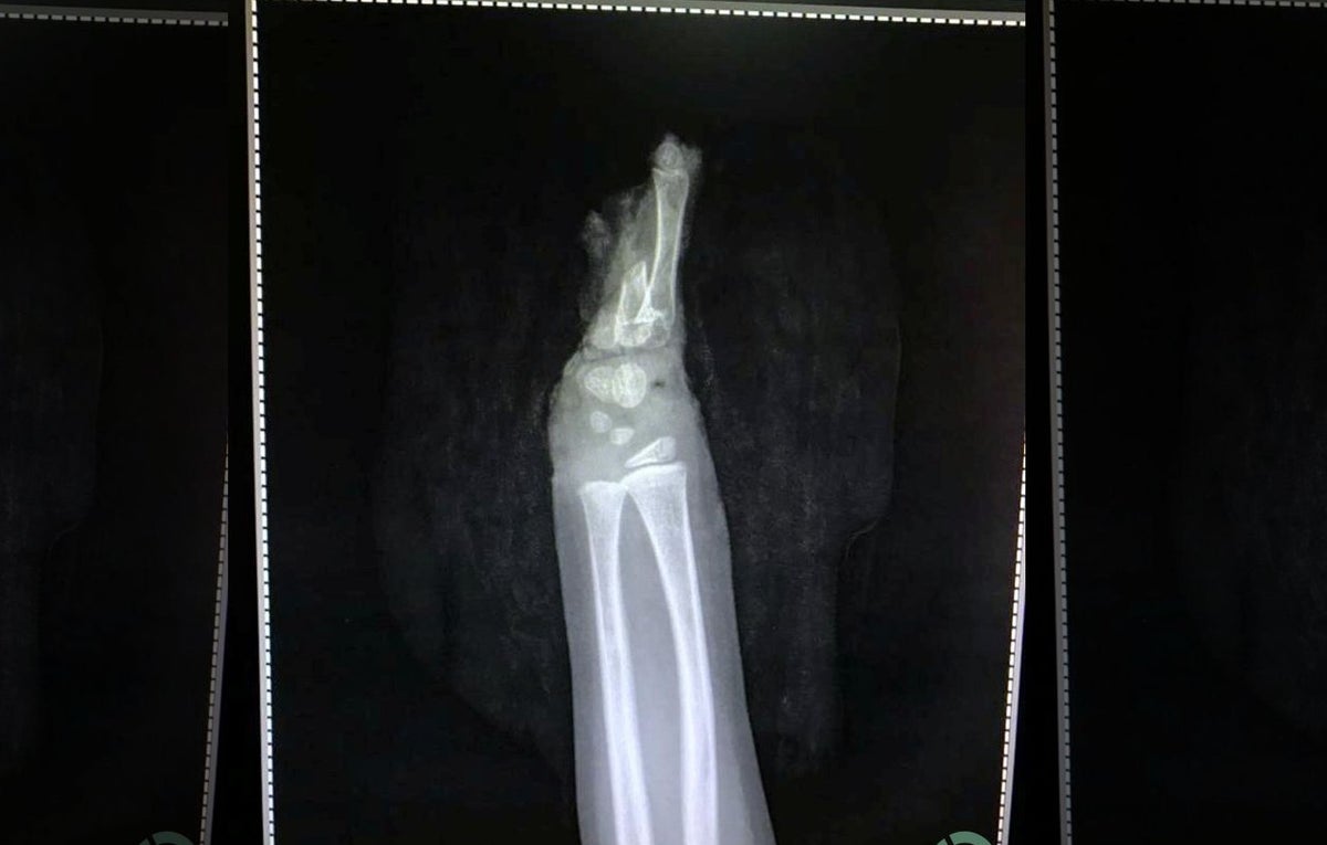 Niño se amputa una mano accidentalmente