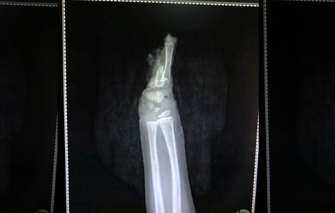 Niño se amputa una mano accidentalmente