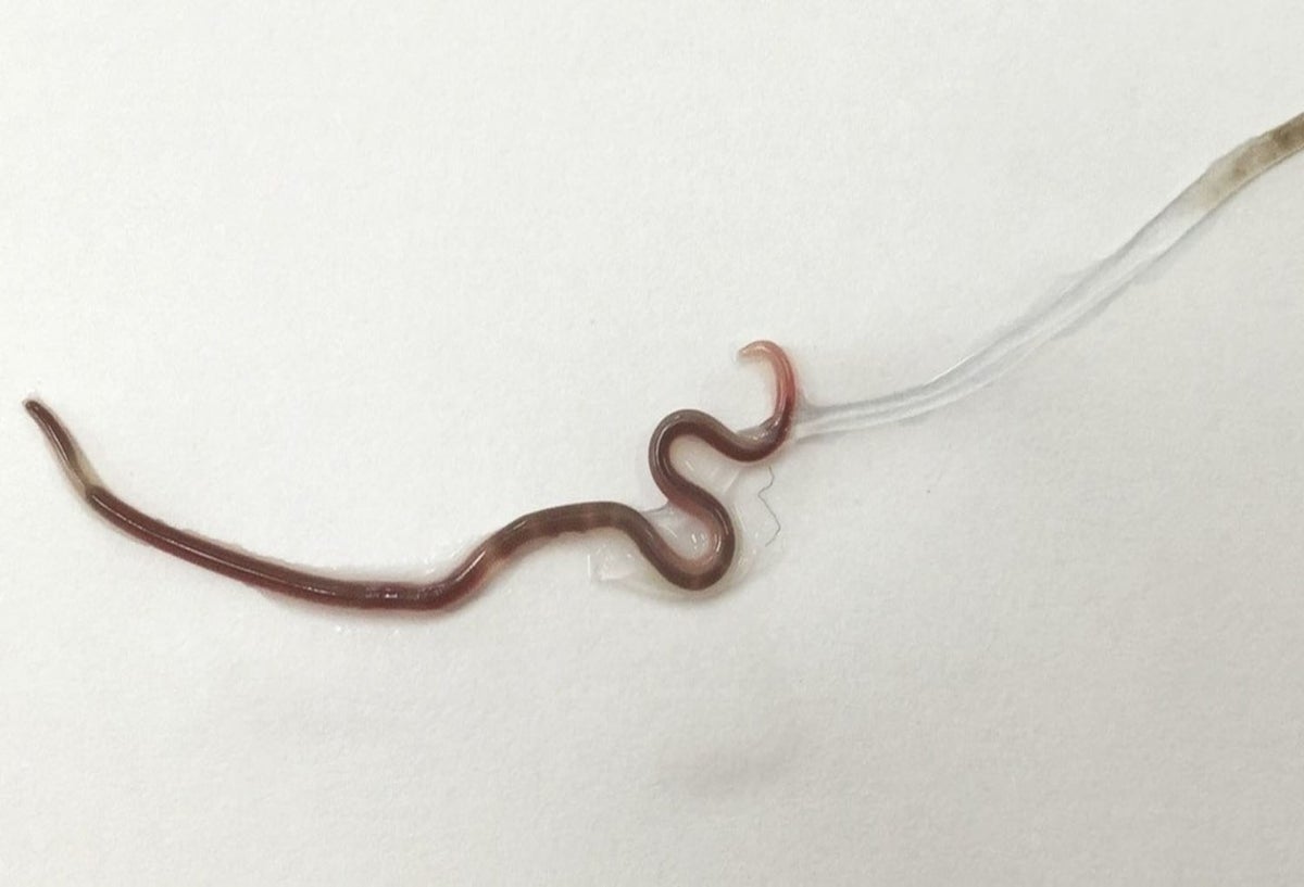 Retiran gusano negro vivo de la amígdala de una mujer