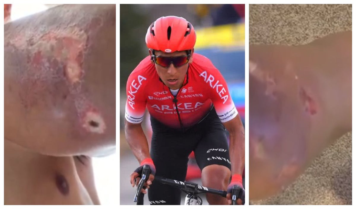 Heridas de Nairo Quintana