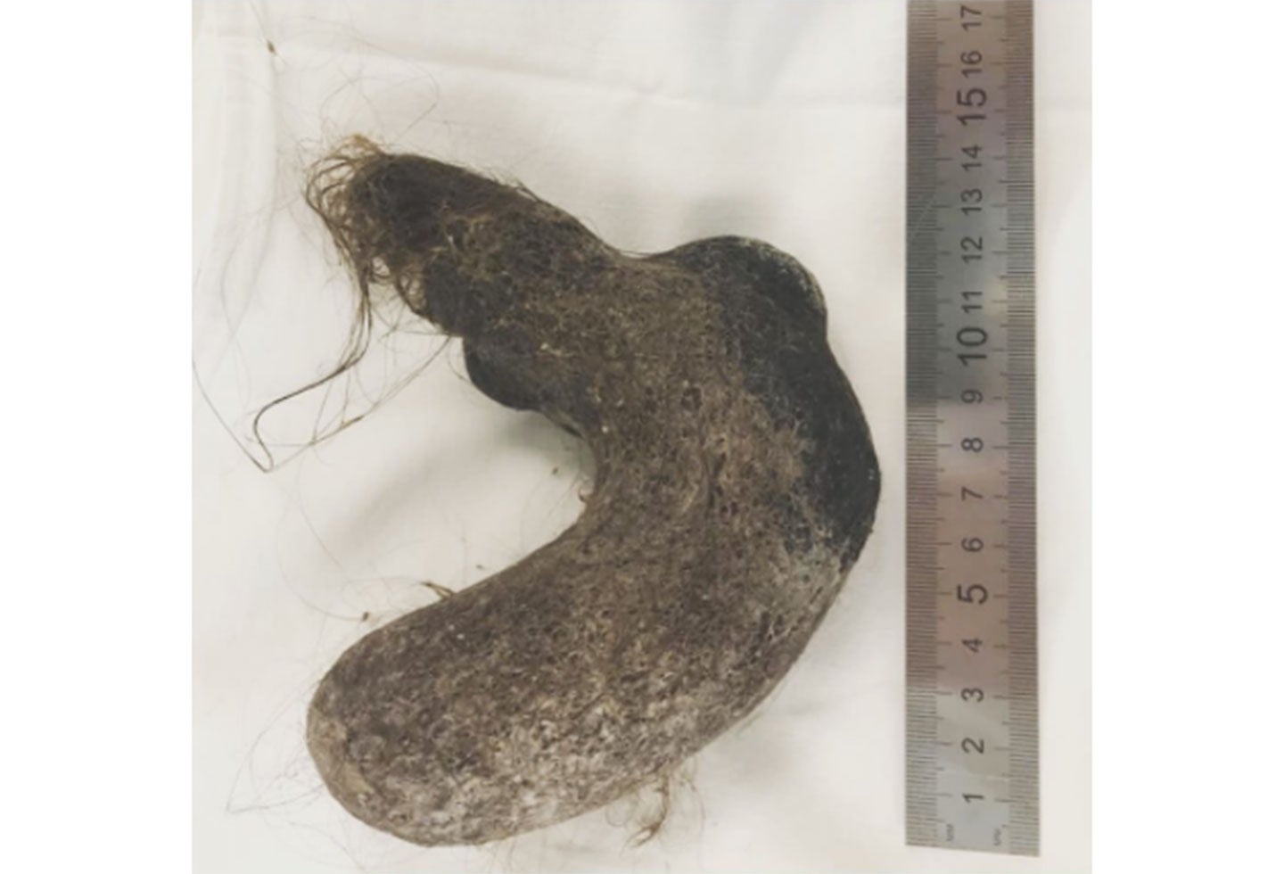 La bola de pelos hallada en estómago de una niña