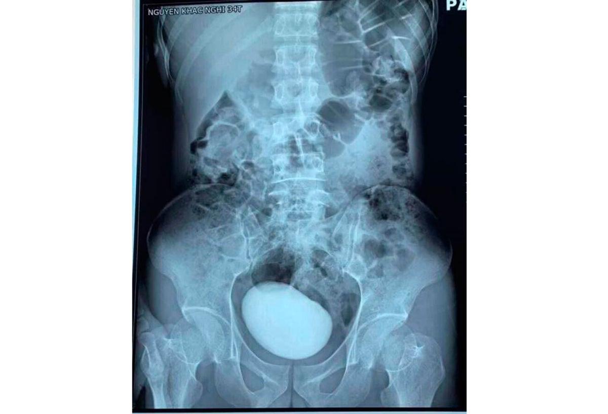 Enorme cálculo extraído a una mujer