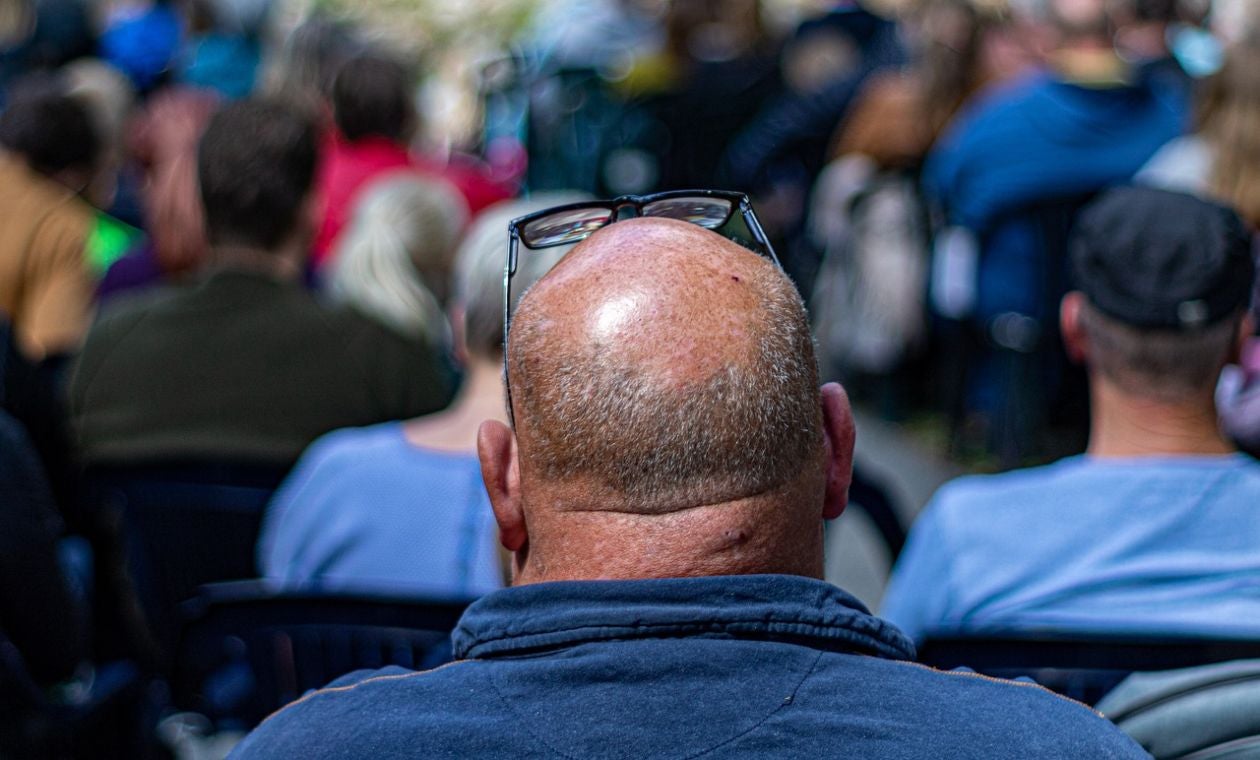 Alopecia en Colombia: ABC de tratamientos efectivos a calvicie en hombres