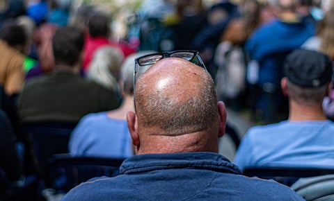 Alopecia en Colombia: ABC de tratamientos efectivos a calvicie en hombres