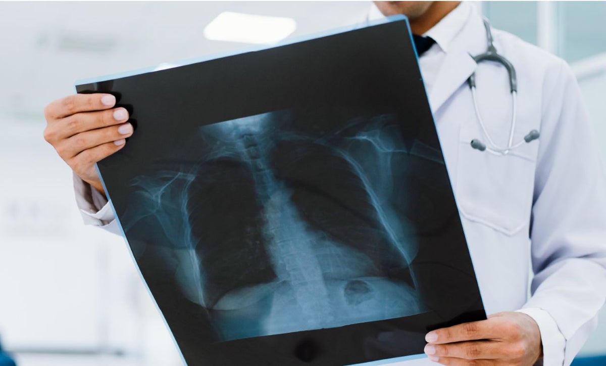 Cáncer de Pulmón cifras en Colombia