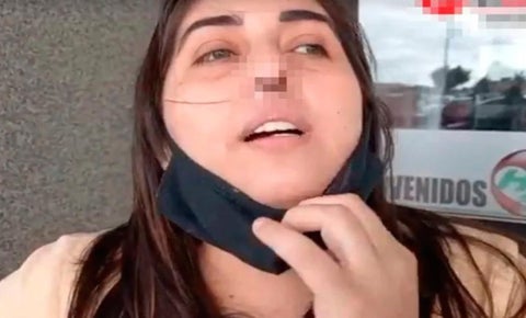 Mujer argentina que perdió el cartílago de su nariz