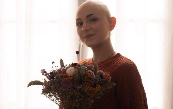Elodicia, joven con alopecia
