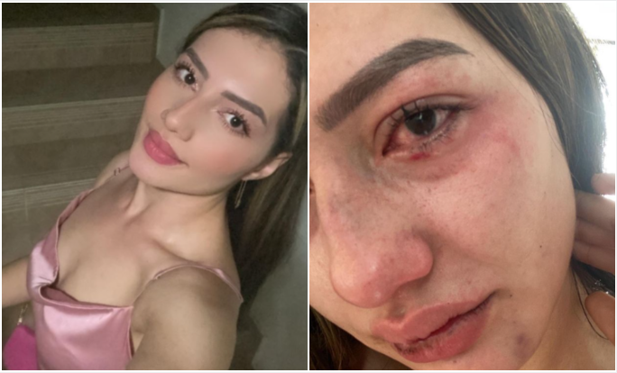 Joven denuncia caso de maltrato físico por parte de su exnovio