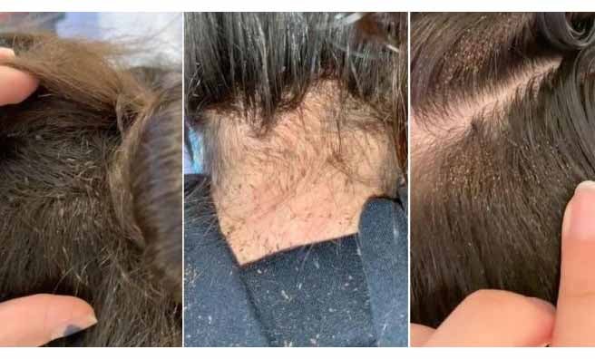 Piojos: niña de 12 años cundida