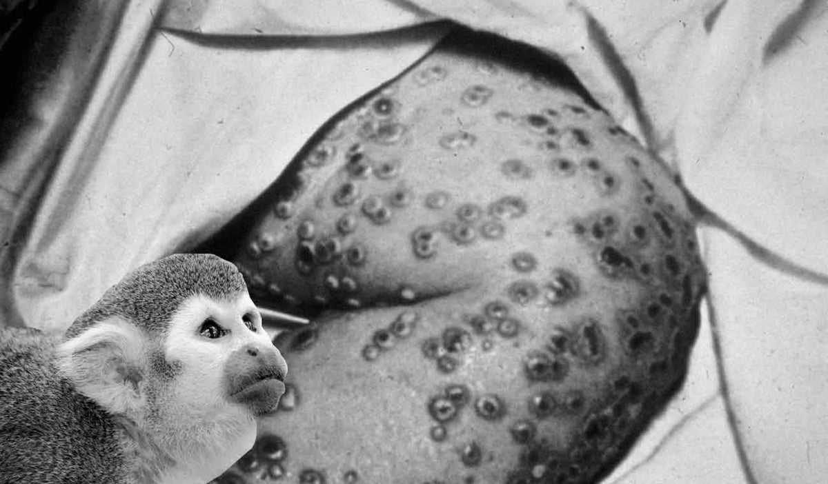 Caso de viruela del mono