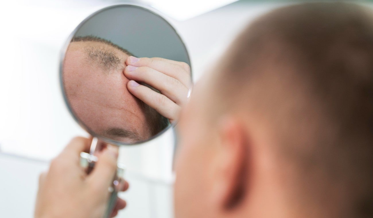 Alopecia en hombres