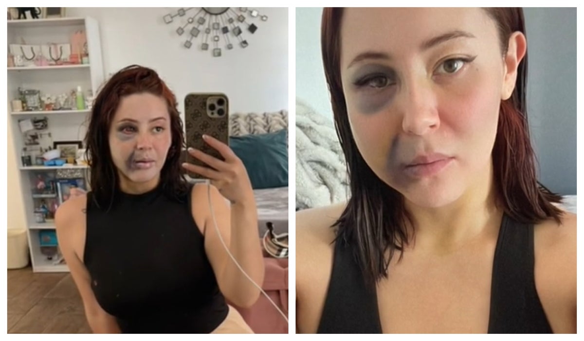 Mujer se hizo una bichectomia y vivió una pesadilla