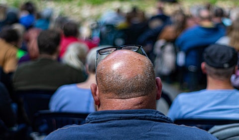 Implantes de pelo en Turquía, ¿cuánto tiempo toma? ¿requiere incapacidad?