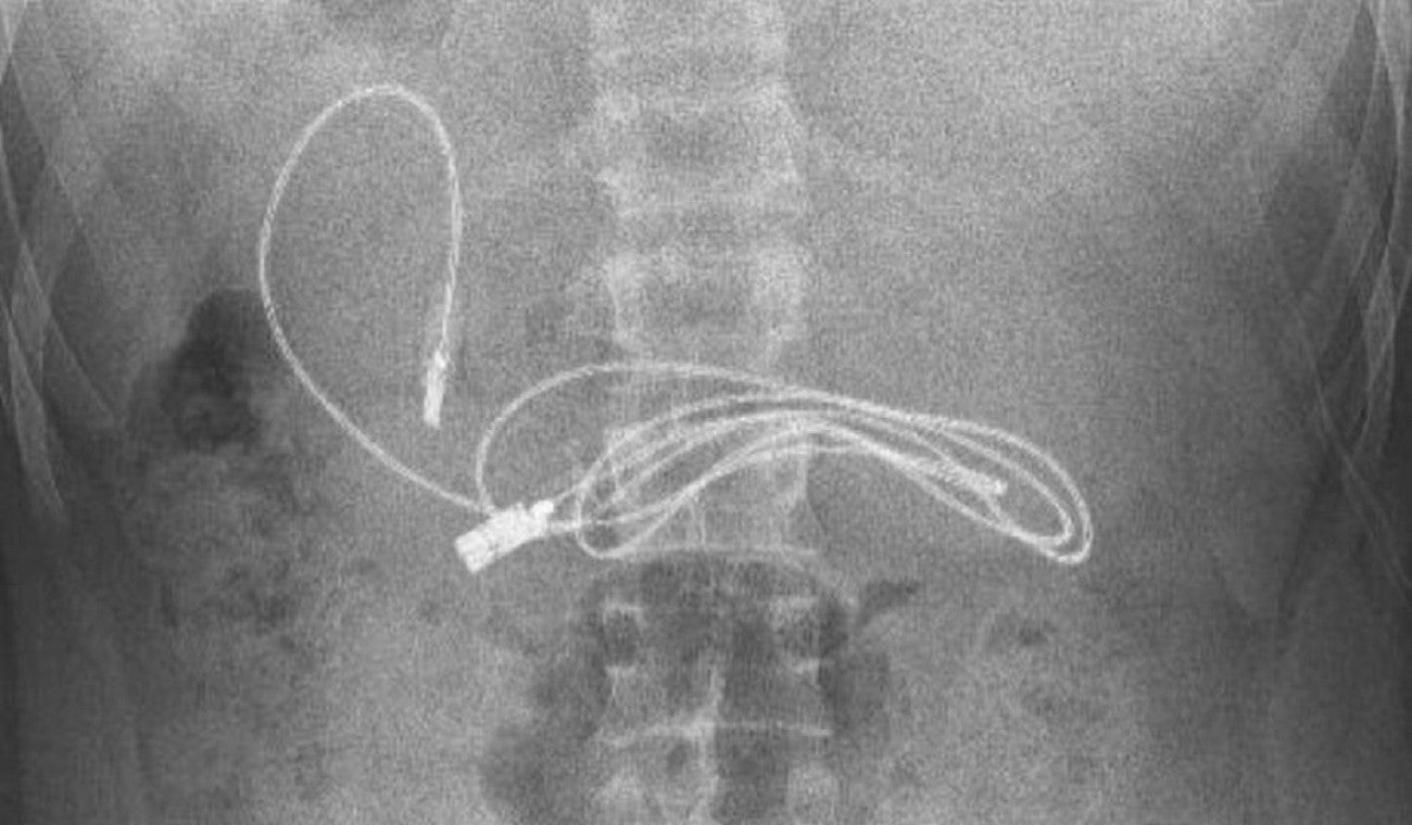 Joven resultó con cable USB en su interior