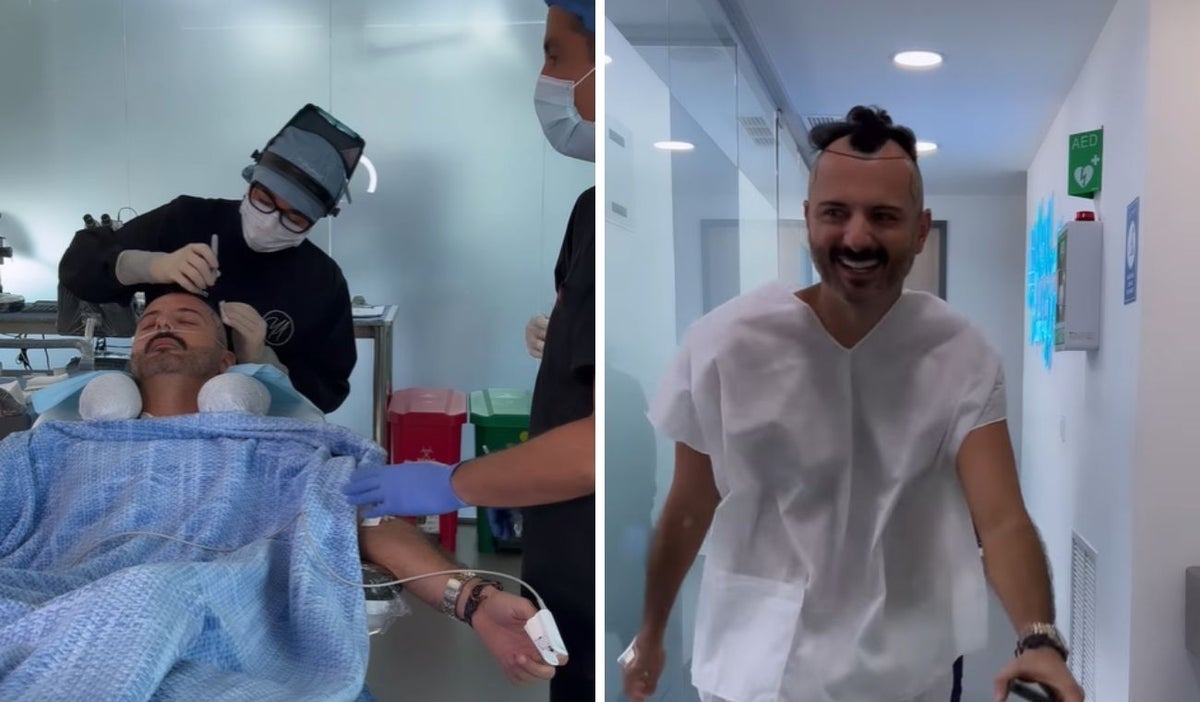 Mario Espitia se hizo un implante capilar