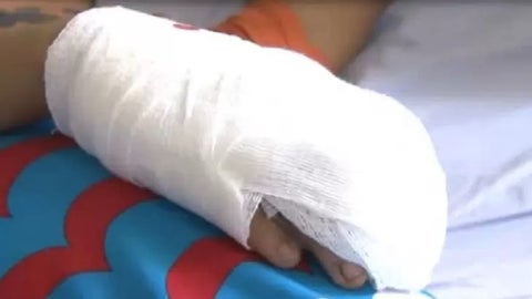 Niño quemado en Antioquia