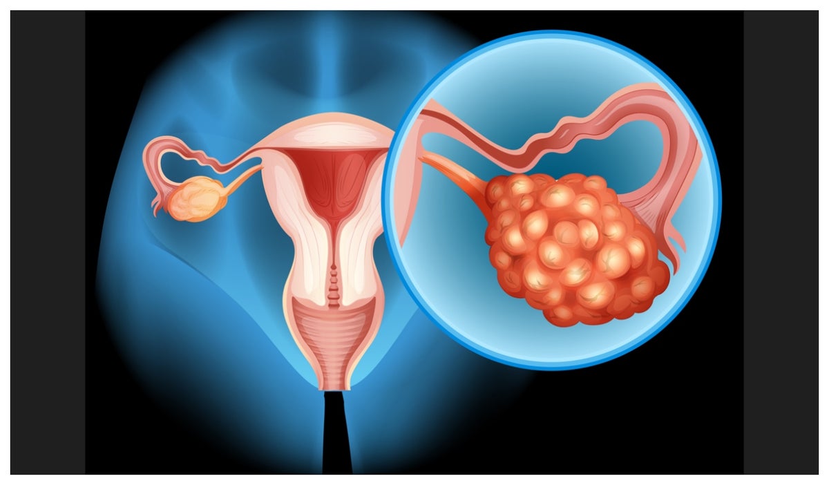 Aparato reproductor femenino y los ovarios