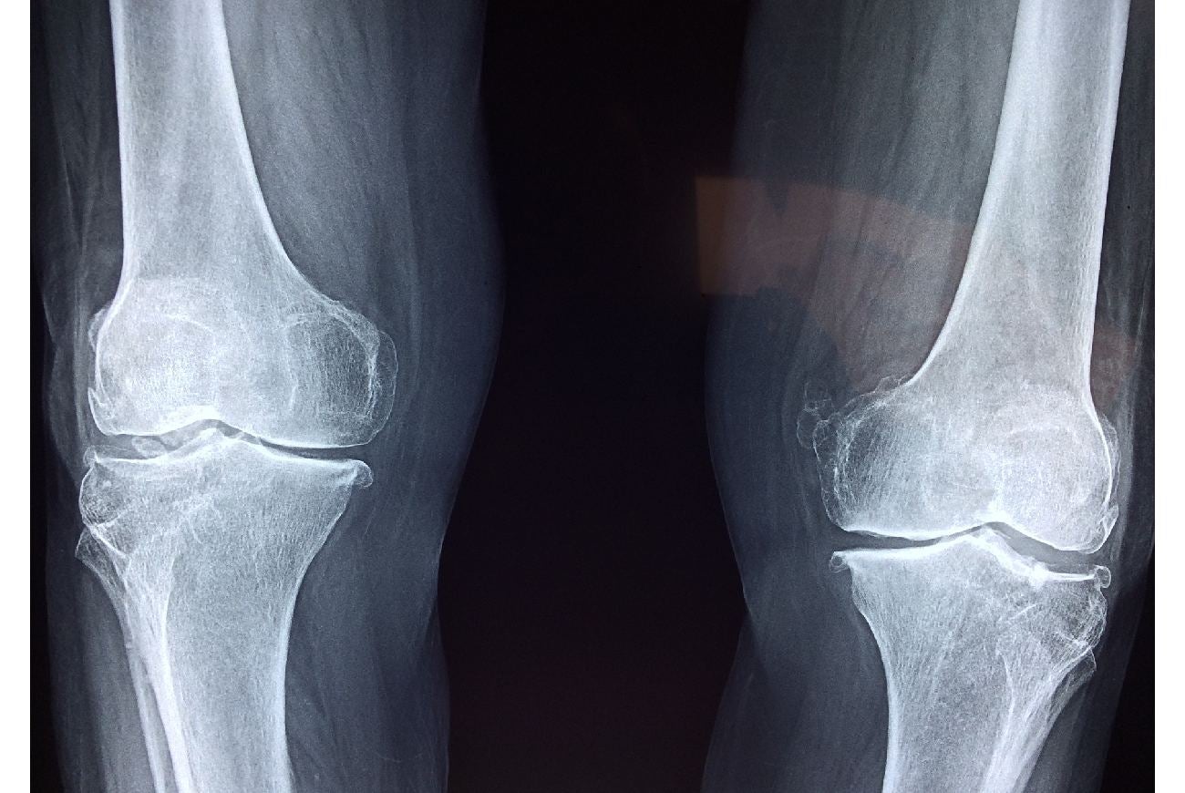Radiografía de rayos X de unas rodillas