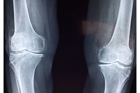 Radiografía de rayos X de unas rodillas