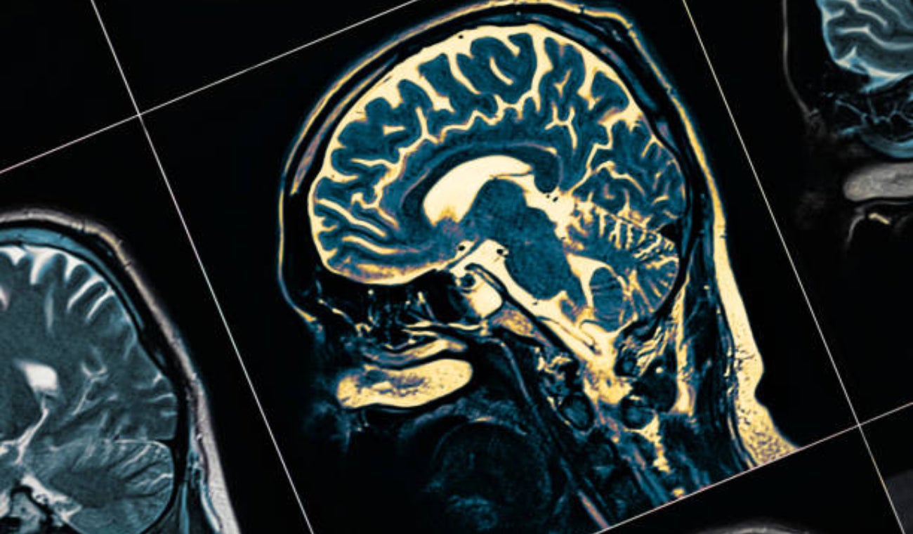 Hombre de 19 años es el paciente más joven con alzheimer a nivel mundial