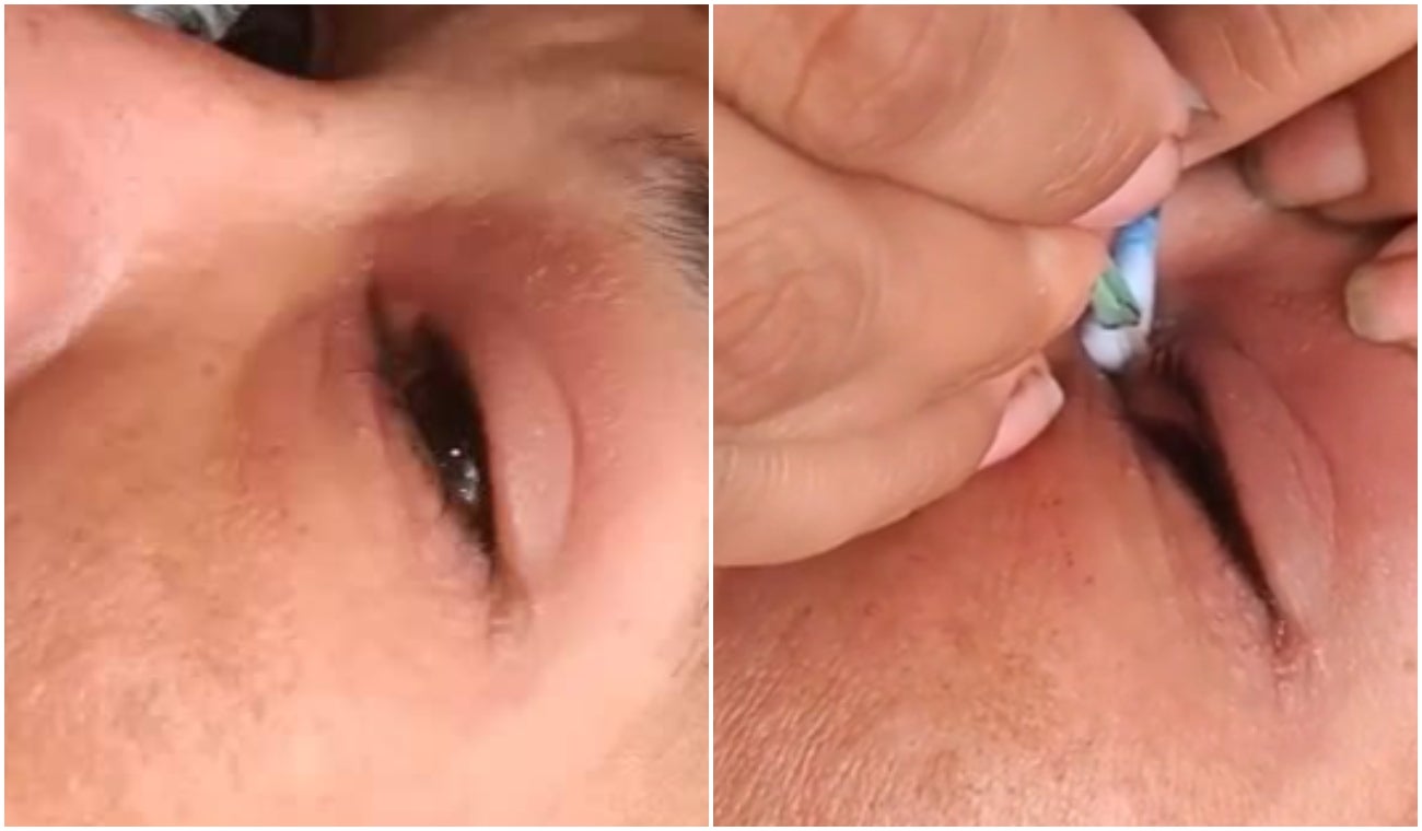 Mujer le extraen gusano del ojo