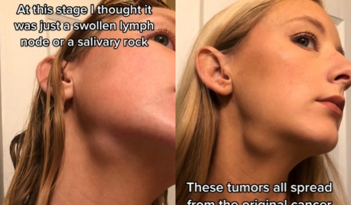 Mujer se dio cuenta que tenía cáncer por reto de TikTok