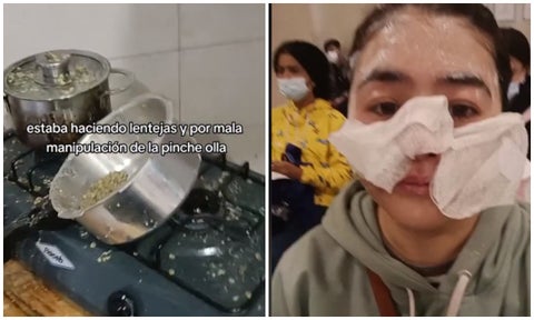 Joven se quemó la cara usando la olla pitadora en Bogotá