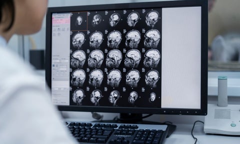 Tumores cerebrales: nuevo fármaco da esperanza a pacientes