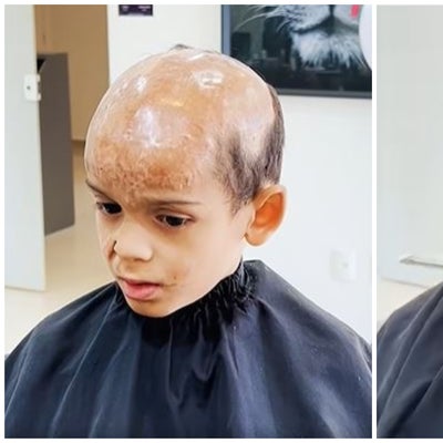 Niño que quedó calvo por quemaduras estrena peluca [VIDEO]