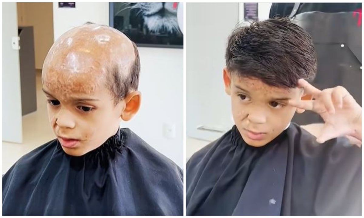 Niño calvo por quemadas ahora tiene pelo: emotivo video