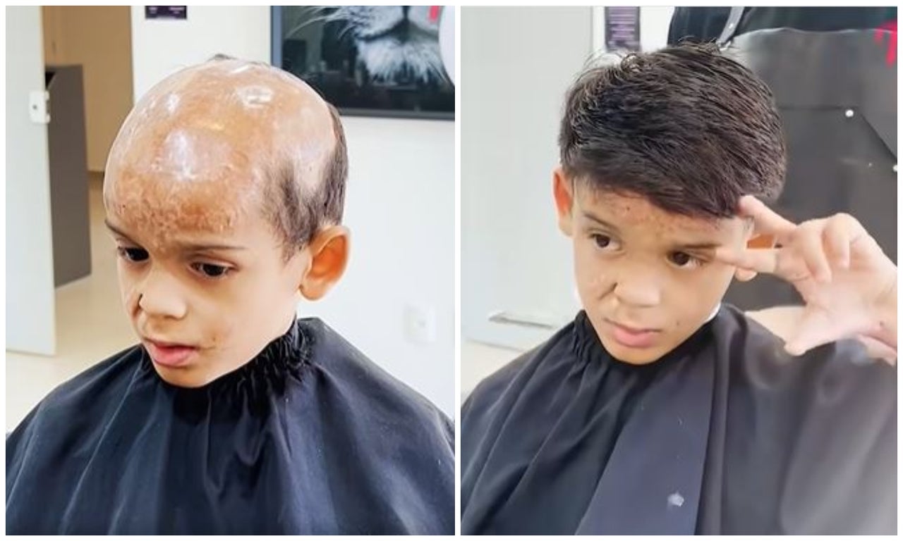 Niño que quedó calvo por quemaduras estrena peluca [VIDEO]