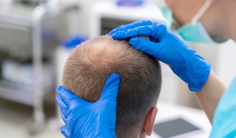 Implantes capilares