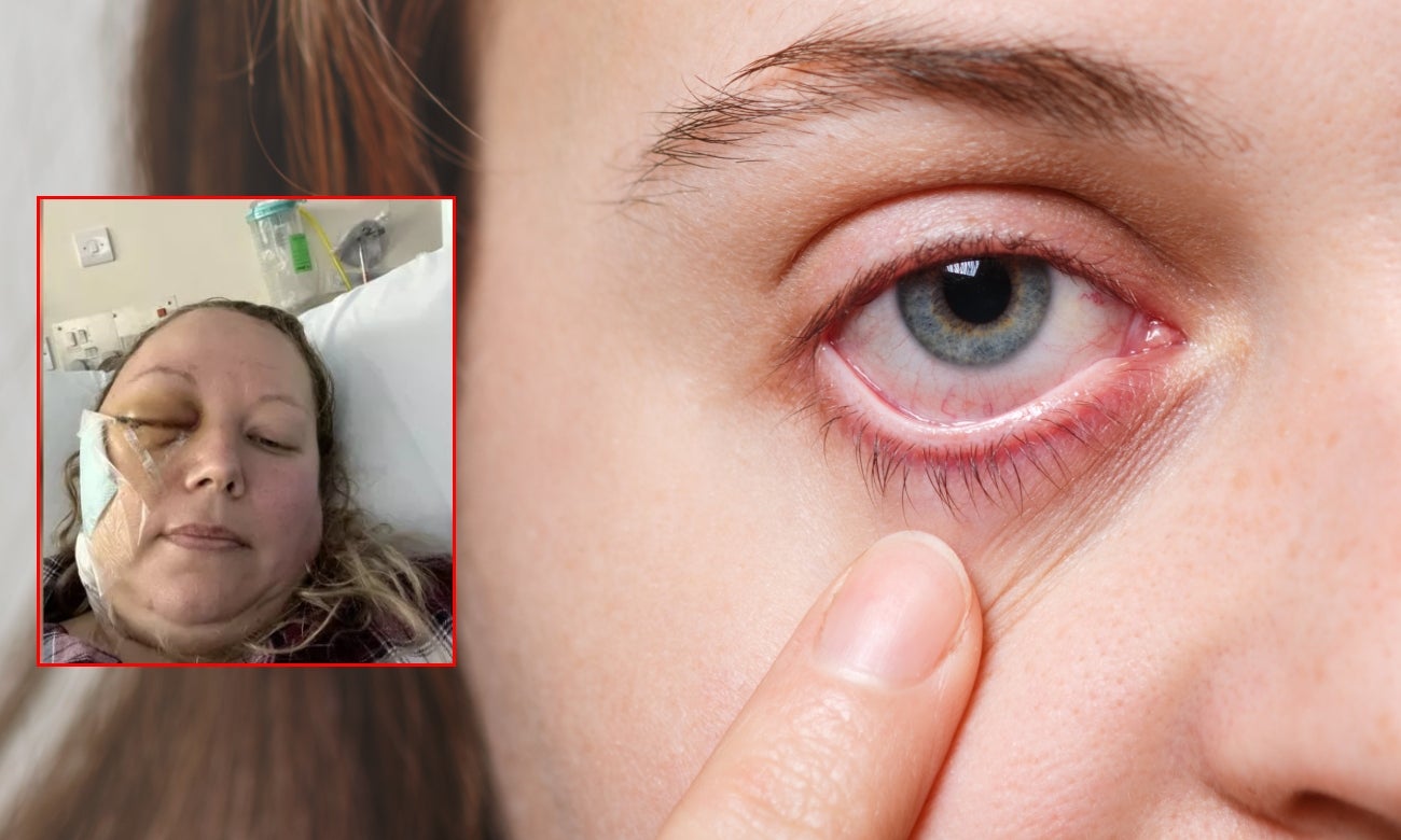 Mujer pensó que tenía un orzuelo y en realidad tenía cáncer cerebral