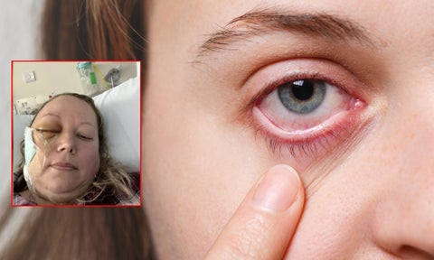 Mujer pensó que tenía un orzuelo y en realidad tenía cáncer cerebral