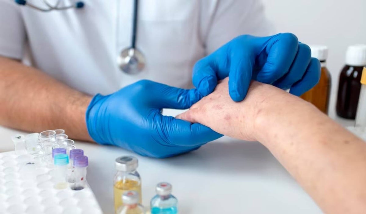 Psoriasis