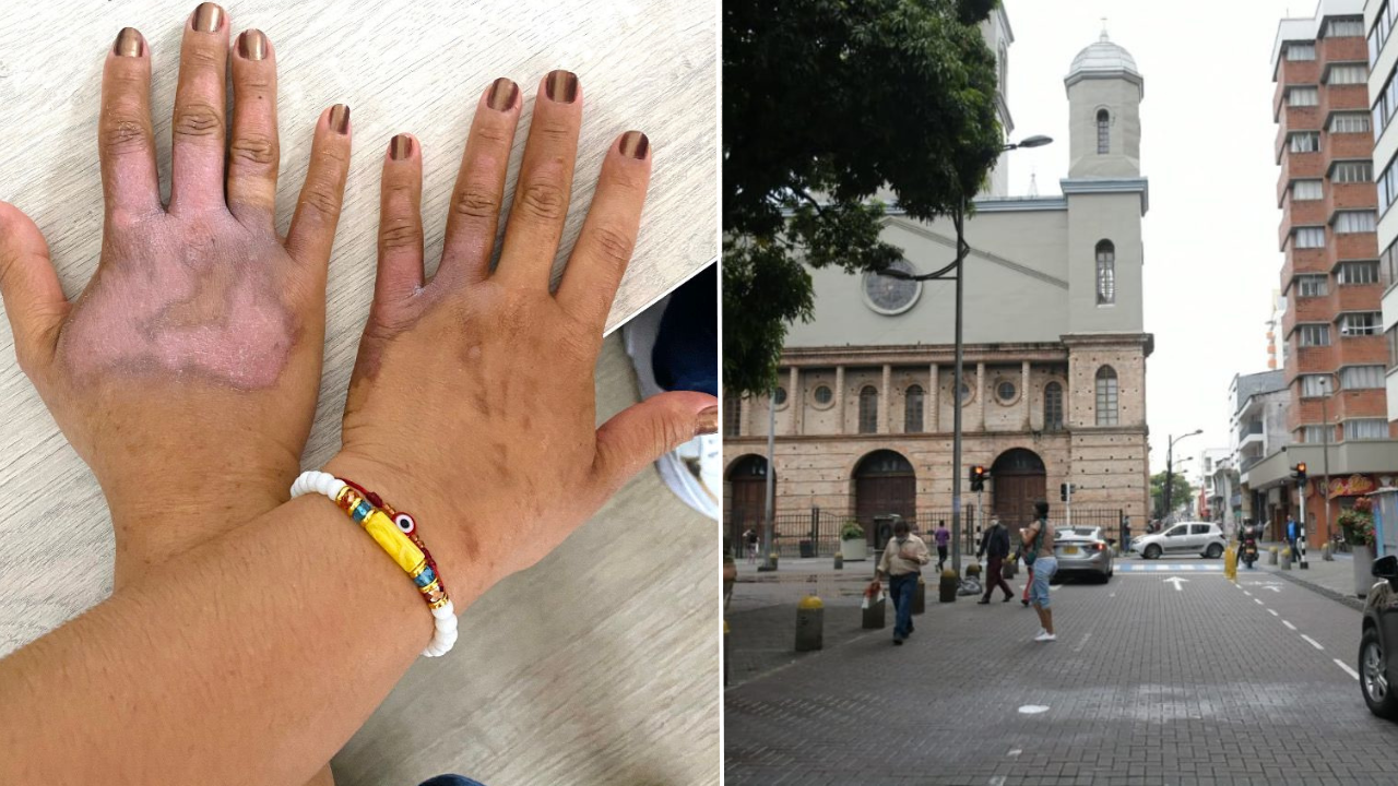 Mujer victima de quemaduras con acido en Pereira
