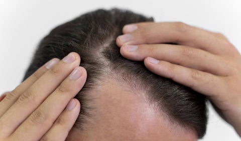 Trasplante de cabello