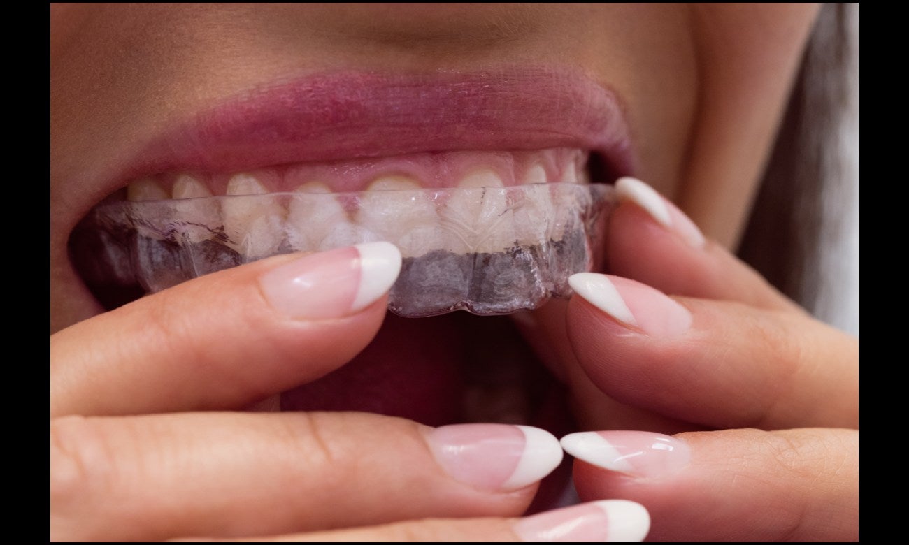 Imagen de referencia sobre alineadores dentales