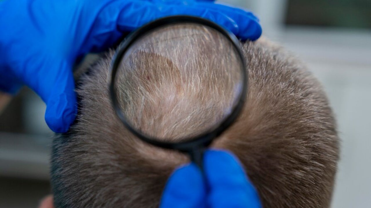 Implantes capilares en Colombia: tecnología avanzada y resultados naturales