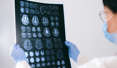 Alzheimer