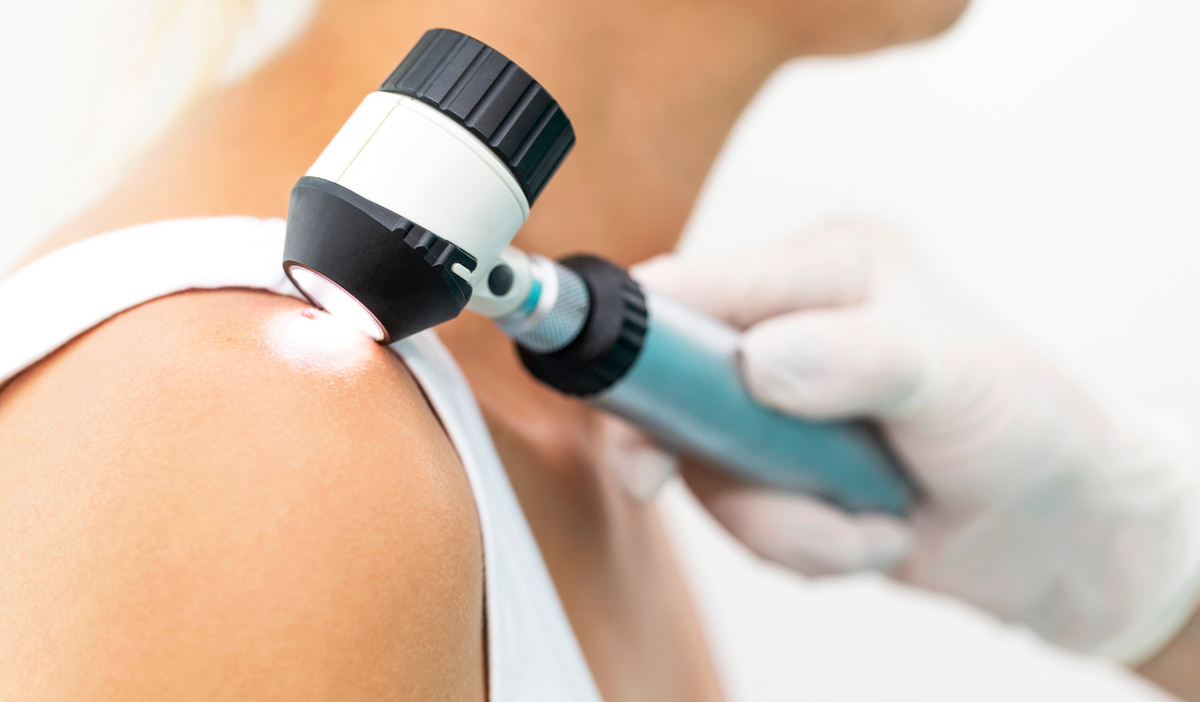 Cinco consejos esenciales para prevenir el cáncer de piel