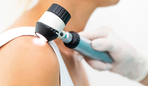 Cinco consejos esenciales para prevenir el cáncer de piel